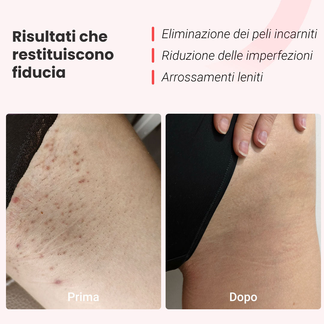 Fotoepilatore a luce pulsata